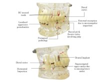 Oktató modell - M4001-2 - caries, apical cyst, tartar, implant, impaction and missing tooth