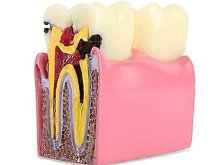 Oktató modell - M4021 - Caries modell