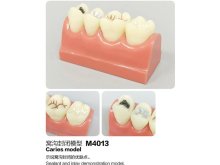 Oktató modell - M4013 - Caries - Sealant - Inlay modell