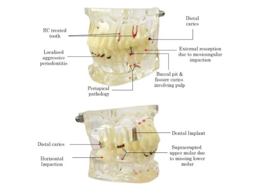 Oktató modell - M4001-2 - caries, apical cyst, tartar, implant, impaction and missing tooth