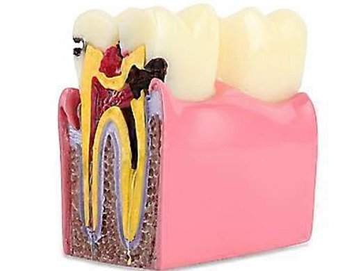 Oktató modell - M4021 - Caries modell