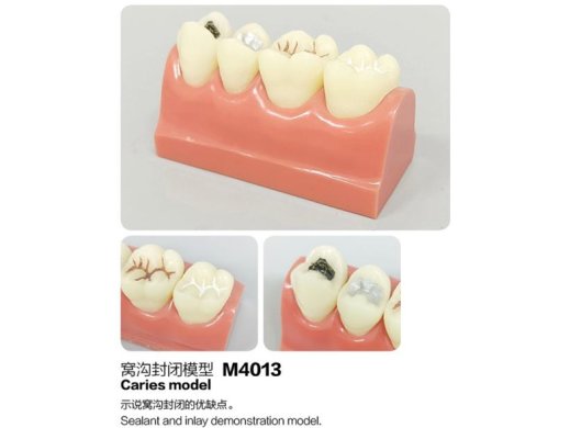 Oktató modell - M4013 - Caries - Sealant - Inlay modell