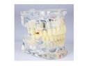 Oktató modell - M4001-2 - caries, apical cyst, tartar, implant, impaction and missing tooth