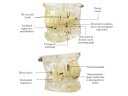 Oktató modell - M4001-2 - caries, apical cyst, tartar, implant, impaction and missing tooth