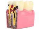 Oktató modell - M4021 - Caries modell