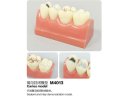 Oktató modell - M4013 - Caries - Sealant - Inlay modell
