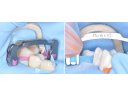 Polírozó csík - 2,5 mm - 6 méter - MEDIUM - Dentpark - Polishing Strips